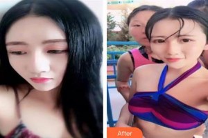 新津志輝醫(yī)院醫(yī)療美容科余科整形價(jià)格表附肋軟骨隆鼻案例展示