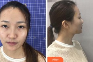 沭陽縣人民醫(yī)院皮膚整形美容科張守俊整形價(jià)格表附鼻部綜合案例展示