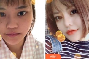 溧陽嘉豐醫(yī)療門診部王錫友整形價(jià)格表附鼻部綜合案例展示