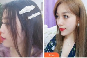 沭陽縣人民醫(yī)院皮膚整形美容科王慶明整形價(jià)格表附鼻部綜合案例展示