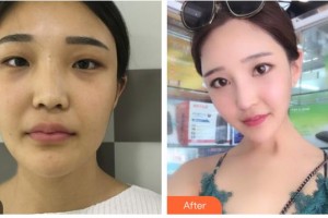 沭陽縣人民醫(yī)院皮膚整形美容科王湘臻住院醫(yī)師整形價(jià)格表附鼻部綜合案例展示