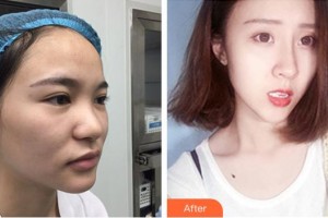 董軍整形價(jià)格表附鼻部綜合案例展示