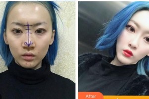 德宏富華醫(yī)學(xué)整形美容門診部李樹興整形價(jià)格表附假體隆鼻案例展示