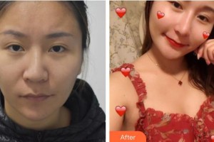 溧陽圣藍(lán)醫(yī)院整形美容中心相汝東整形價(jià)格表附鼻修復(fù)案例展示