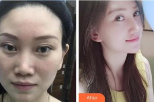 張佑陽整形價(jià)格表附鼻部綜合案例展示