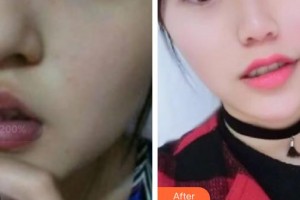 張掖星范整形美容醫(yī)院羅虹霞整形價(jià)格表附微針去頸紋案例展示