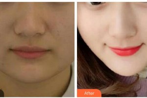 雙鴨山孫笠醫(yī)療美容診所孫力整形價(jià)格表附埋線提升案例展示