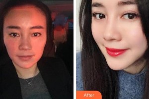 泰興柏麗整形美容醫(yī)院姚為群整形價(jià)格表附埋線提升案例展示