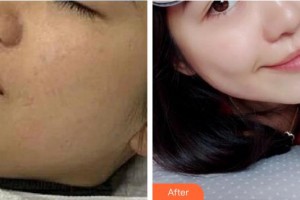 惠州劉偉勇醫(yī)療美容診所劉偉勇整形價(jià)格表附激光美膚激光案例展示