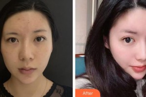 陽江市人民醫(yī)院燒傷整形外科李孟和整形價(jià)格表附埋線提升案例展示