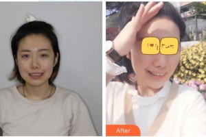 溧陽嘉豐醫(yī)療門診部董欽曉整形價(jià)格表附牙齒隱形矯正案例展示