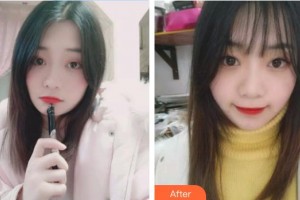 永年李婷醫(yī)院整形科李婷整形價(jià)格表附金屬托槽矯正案例展示