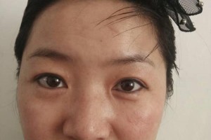 云大醫(yī)院激光祛斑果怎么樣附果圖