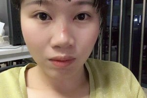 信陽中心醫(yī)院雙眼皮怎么樣附價格表