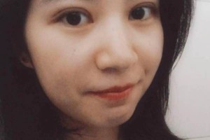 ?復(fù)旦大學(xué)附屬中山醫(yī)院怎么樣？附埋線雙眼皮果圖