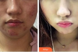 伊禮剛整形價(jià)格表附清潔祛痘案例展示