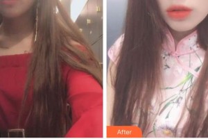 安岳潤白顏醫(yī)療整形美容門診部蔣永強(qiáng) 整形價(jià)格表附紅藍(lán)光祛痘案例展示