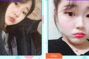 鞍鋼集團(tuán)總醫(yī)院醫(yī)療美容醫(yī)院馬曉文整形價(jià)格表附無針?biāo)獍咐故?>
</a>
<h3 class=