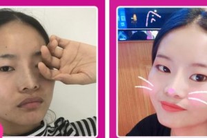 張掖華美醫(yī)療美容醫(yī)院彭書強(qiáng)整形價(jià)格表附去痘印痘坑案例展示