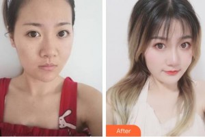 克拉瑪依市中心醫(yī)院燒傷整形科王會(huì)軍整形價(jià)格表附去痘印痘坑案例展示