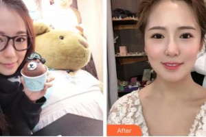 溧陽幫明口腔門診部馬金盼整形價(jià)格表附金屬托槽矯正案例展示