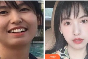 吳江邵新農(nóng)口腔診所劉芳兵整形價(jià)格表附金屬托槽矯正案例展示