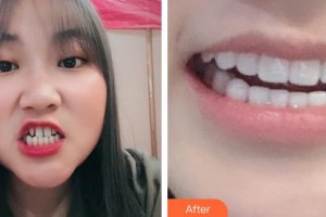 高郵海潮口腔門診部吳耀明整形價(jià)格表附牙貼面案例展示