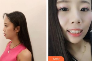 楚雄龐氏口腔門診部王蔚整形價(jià)格表附牙齒隱形矯正案例展示