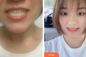 楚雄龐氏口腔門診部高恩峰整形價(jià)格表附牙齒隱形矯正案例展示