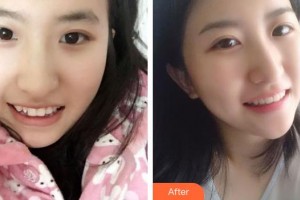 楚雄龐氏口腔門診部胡長紅整形價(jià)格表附牙齒隱形矯正案例展示