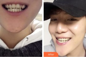 西藏阜康醫(yī)院口腔科莊慶整形價(jià)格表附牙齒隱形矯正案例展示