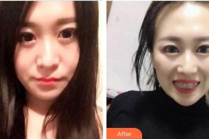 西藏阜康醫(yī)院口腔科范贇韜整形價(jià)格表附金屬托槽矯正案例展示