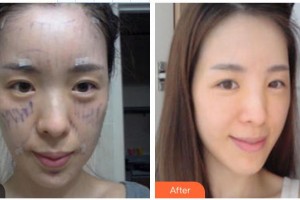 翁瑞主診醫(yī)師整形價(jià)格表附熱拉提案例展示