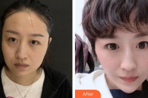 首都醫(yī)科大學(xué)附屬復(fù)興醫(yī)院整形美容中心高尚整形價(jià)格表附埋線提升案例展示