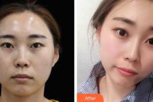 成武縣人民醫(yī)院醫(yī)學(xué)美容科邵兆銀住院醫(yī)師整形價(jià)格表附熱瑪吉案例展示