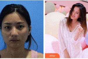 張掖市人民醫(yī)院美容整形科張著杰整形價(jià)格表附埋線提升案例展示