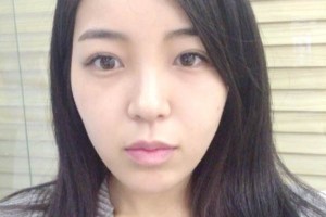 上海同濟(jì)整形醫(yī)院雙眼皮手術(shù)果案例對(duì)比圖