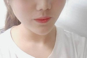 北醫(yī)三院雙眼皮李東怎么樣附價(jià)格表