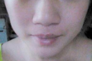 寧波二院美容科怎么樣割雙眼皮那個醫(yī)生好|案例