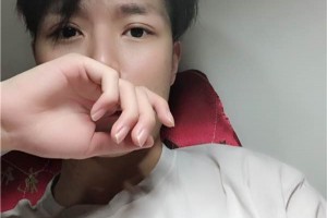 汕頭附一醫(yī)院整形好不好割雙眼皮全過(guò)程|醫(yī)生推薦