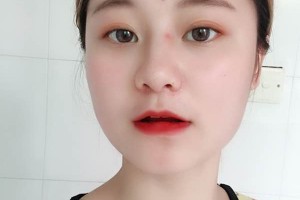 杭州芯美昕整形醫(yī)院怎么樣割雙眼皮案例全過程