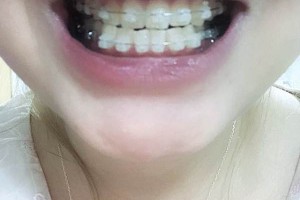 廣州安美口腔門(mén)診部怎么樣牙齒矯正果分享