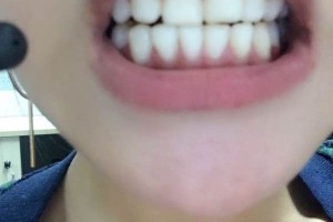 大慶康美口腔醫(yī)院怎么樣牙齒矯正案例|價格表