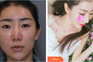 酒泉醫(yī)學(xué)整形美容門診部李士剛整形價格表附鼻部綜合案例展示