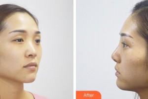 酒泉醫(yī)學(xué)整形美容門診部楊艷整形價格表附假體隆鼻案例展示