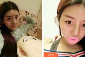 平?jīng)隹得泪t(yī)療美容門診部孫小虎整形價格表附耳軟骨復(fù)合隆鼻案例展示