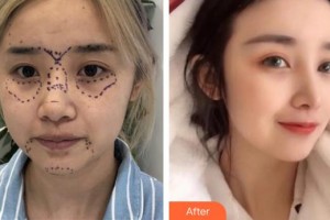 中航工業(yè)三六四醫(yī)院醫(yī)療美容科辛華整形價格表附鼻部綜合案例展示