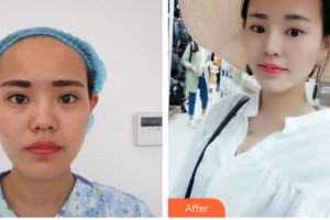 南海華美整形美容醫(yī)院莫冰冰整形價格表附假體隆鼻案例展示