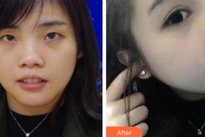 江都市婦幼保健院醫(yī)學(xué)美容科于萍整形價格表附硅膠隆鼻案例展示