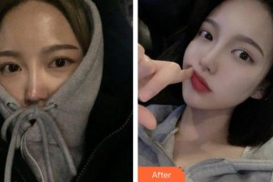 河間麗達醫(yī)療美容診所王衛(wèi)軍整形價格表附鼻部綜合案例展示